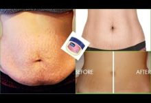 How to Use Vaseline and The Cream for Stretch Mark