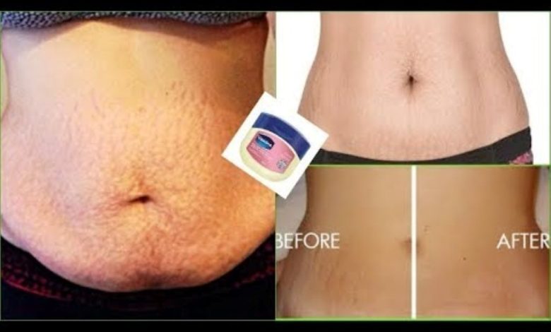 How to Use Vaseline and The Cream for Stretch Mark