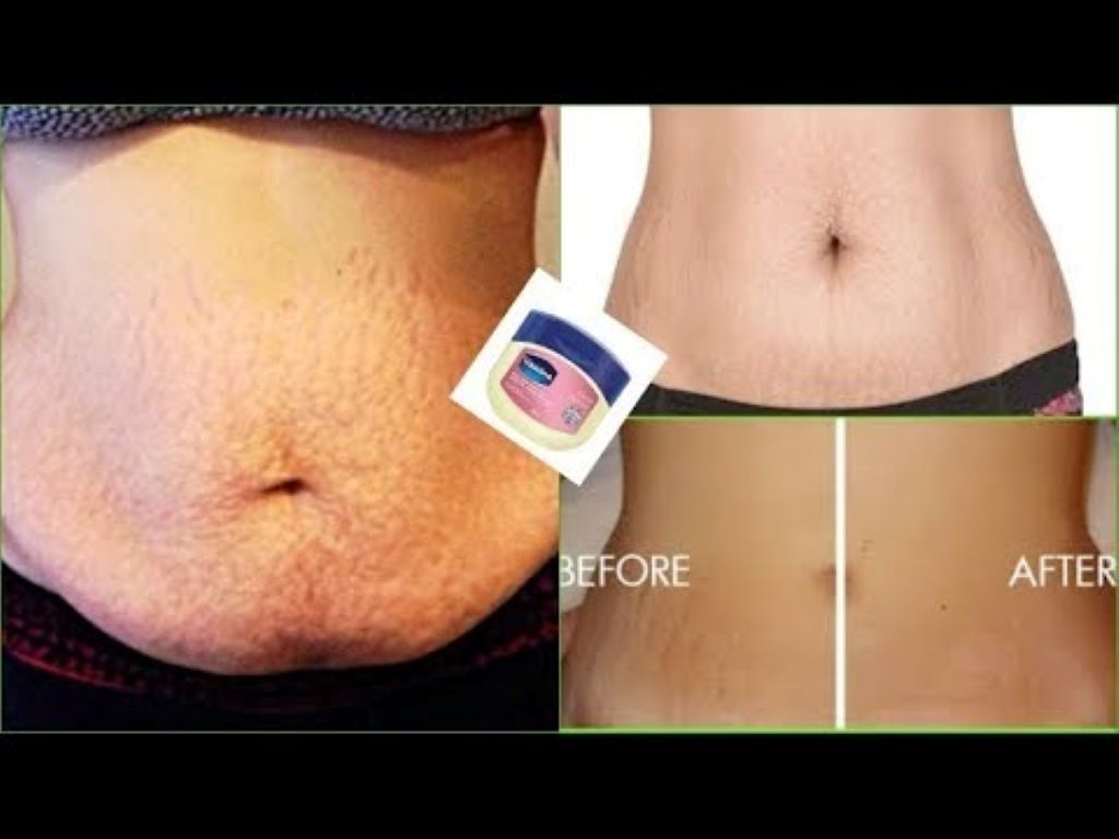 How to Use Vaseline and The Cream for Stretch Mark